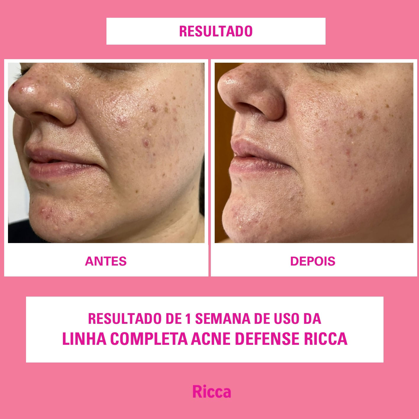 Sabonete Líquido Facial Acne Defense Ricca - Ricca